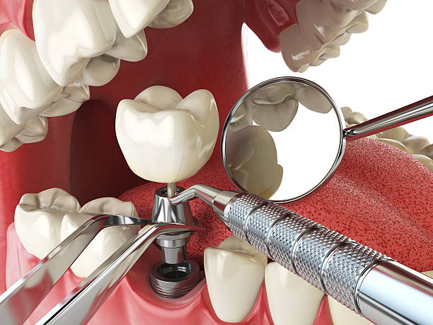 Best Emergency Tooth Extraction in Panacea, FL